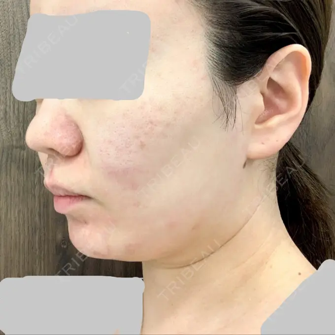 糸リフト / 肌ヒアルロン酸注入（たるみ・シワ改善） TCB東京中央美容外科 中野院 BEFORE メイン用