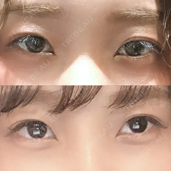 二重埋没 / 目頭切開 ドクター松井クリニック 新宿 BEFORE メイン用