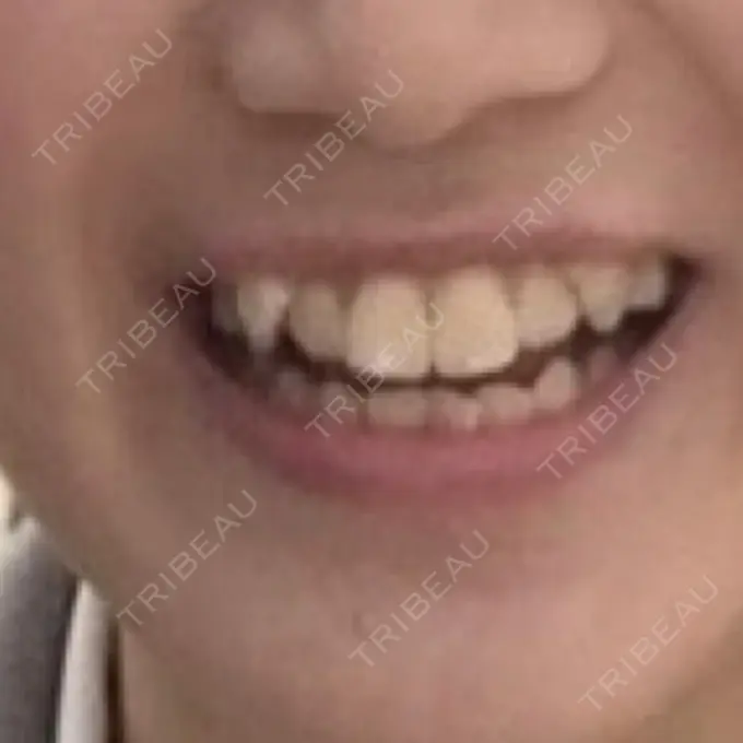 矯正（ワイヤー） 表参道ヒカリデンタル矯正歯科 BEFORE メイン用