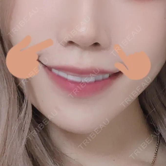 シワ取りボトックス / その他（鼻） もとび美容外科クリニック 新宿院 BEFORE メイン用