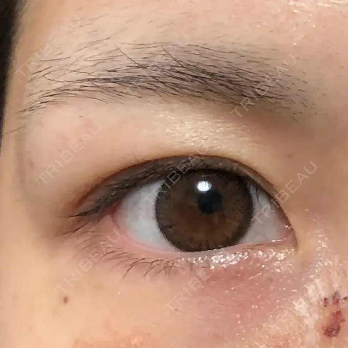 眉下切開 もとび美容外科クリニック 新宿院 BEFORE メイン用