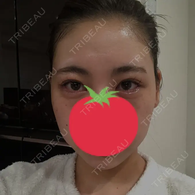 二重切開 / 目頭切開 / クマ治療 / バッカルファット除去 / 脂肪吸引（顔） / 額を丸く / 目尻切開 ヴェリテクリニック 名古屋院 BEFORE メイン用