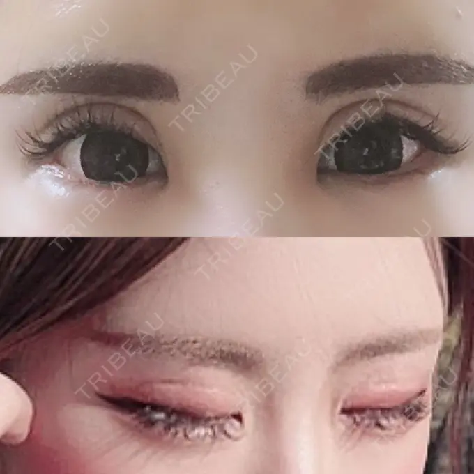 二重切開 / 目元修正 心斎橋コムロ美容外科クリニック BEFORE メイン用