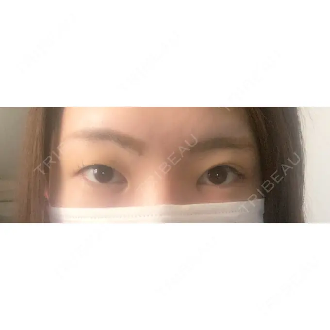 二重埋没 / 上まぶたの脂肪取り 札幌中央クリニック BEFORE メイン用