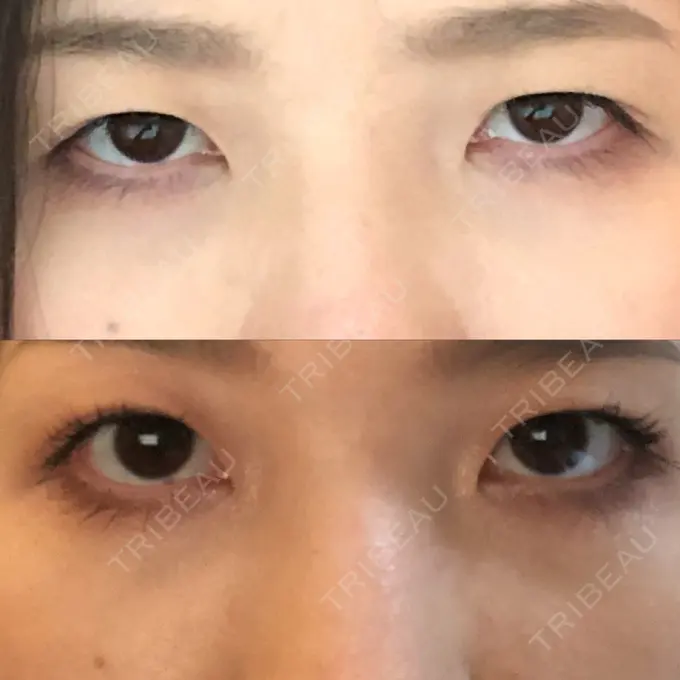 眼瞼下垂（切開） あきこクリニック BEFORE メイン用