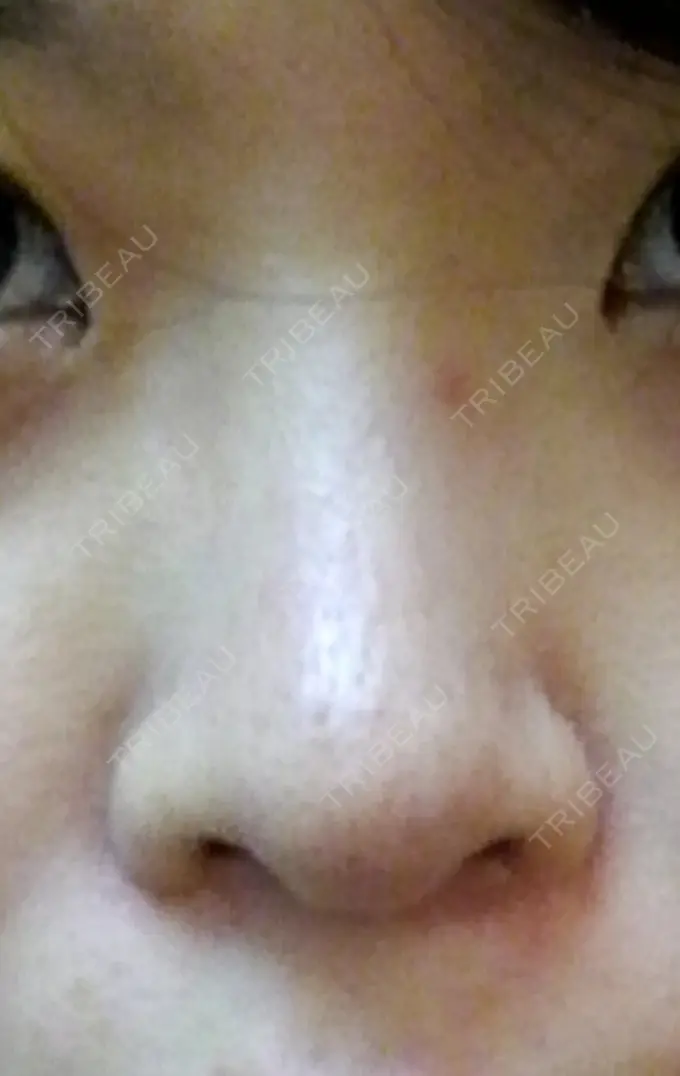 隆鼻術 / 鼻尖形成（切開） / 軟骨移植 ヤスミクリニック BEFORE メイン用