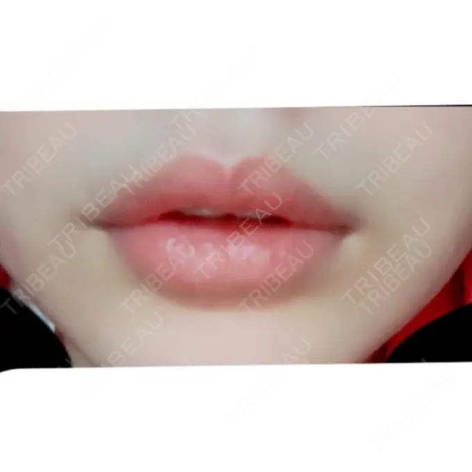 口唇縮小術 ビスポーククリニック 福岡院 BEFORE メイン用