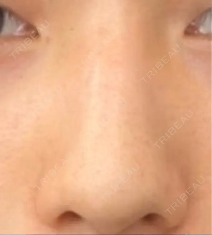 鼻尖形成（切開） / レディエッセ注入（鼻） LETICIA CLINIC（レティシア クリニック） BEFORE メイン用