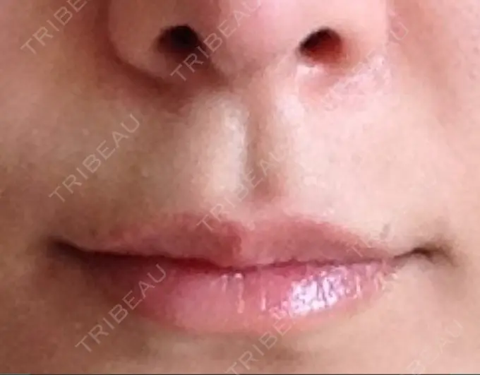 小鼻縮小（切開） / 人中短縮 南クリニック BEFORE メイン用