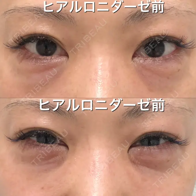 クマ治療 / タレ目形成・グラマラスライン（切開） / その他（目元） BIANCA銀座 BEFORE メイン用