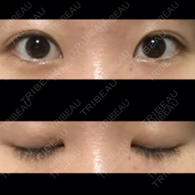 二重埋没 東京形成美容外科 船橋院 BEFORE メイン用