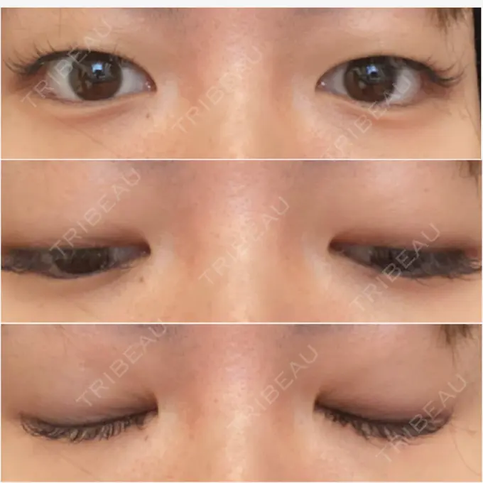 二重埋没 湘南美容クリニック 東京蒲田院 BEFORE メイン用