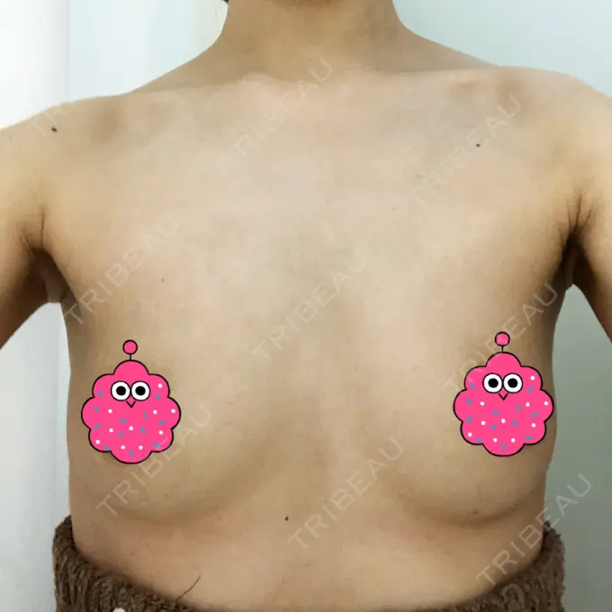 豊胸（シリコンバッグ） あつぎ美容クリニック BEFORE メイン用