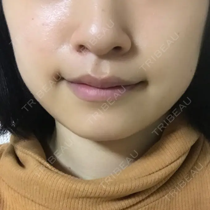 脂肪吸引（顔） 湘南美容クリニック 京都院 BEFORE メイン用