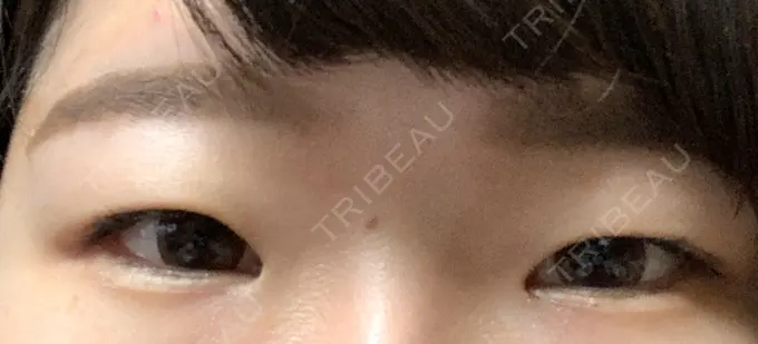 二重埋没 湘南美容クリニック 京都院 BEFORE メイン用