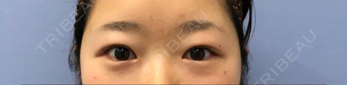 上まぶたの脂肪取り / 眉下切開 湘南美容クリニック 秋葉原院 BEFORE メイン用