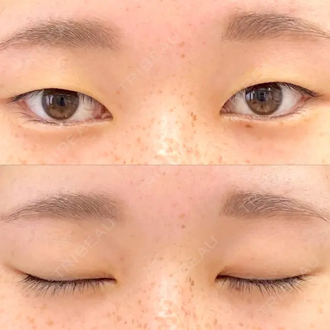 二重埋没 フェアクリニック川口 BEFORE メイン用