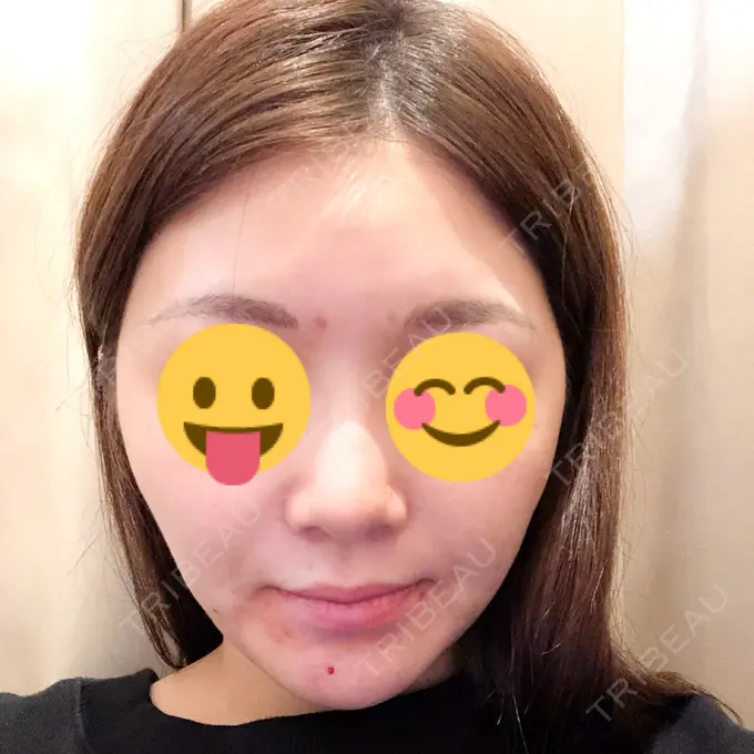 脂肪吸引（顔） / メーラーファット除去 湘南美容クリニック 秋葉原院 BEFORE メイン用