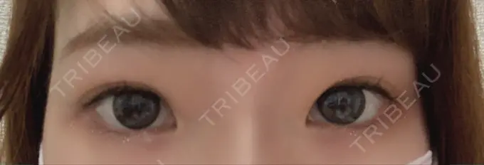 タレ目形成・グラマラスライン（切開） / ボトックス（タレ目） TCB東京中央美容外科 宇都宮院 BEFORE メイン用