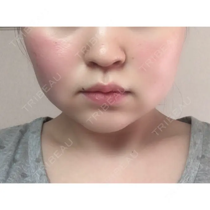 脂肪溶解注射（顔） 赤坂プレミアクリニック BEFORE メイン用