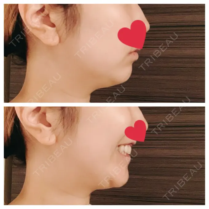 糸リフト / バッカルファット除去 / 脂肪吸引（顔） / メーラーファット除去 / ボトックス（あご） WOM CLINIC GINZA （ワム クリニック ギンザ） BEFORE メイン用