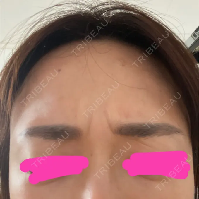 シワ取りボトックス 湘南美容クリニック 自由が丘院 BEFORE メイン用