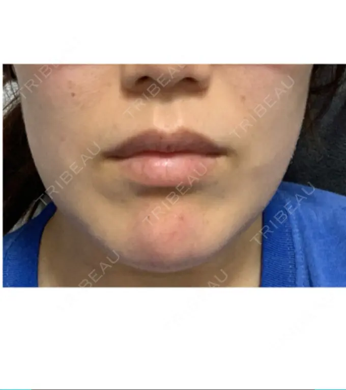 ボトックス（あご） TCB東京中央美容外科 心斎橋筋院 BEFORE メイン用