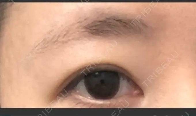 眉下切開 湘南美容クリニック 秋葉原院 BEFORE メイン用