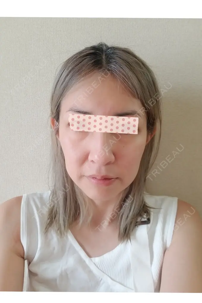 二重埋没 / 糸リフト / クマ治療 / 額を丸く / 下まぶたたるみ取り / 下まぶたの脂肪取り / 脂肪注入（額） / 脂肪注入（輪郭） 湘南美容クリニック 自由が丘院 BEFORE メイン用