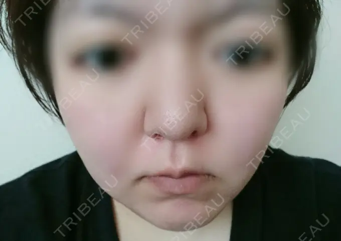 脂肪冷却（輪郭） 湘南美容クリニック 町田院 BEFORE メイン用