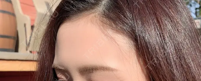 ヒアルロン酸注入（額） 赤坂プレミアクリニック BEFORE メイン用