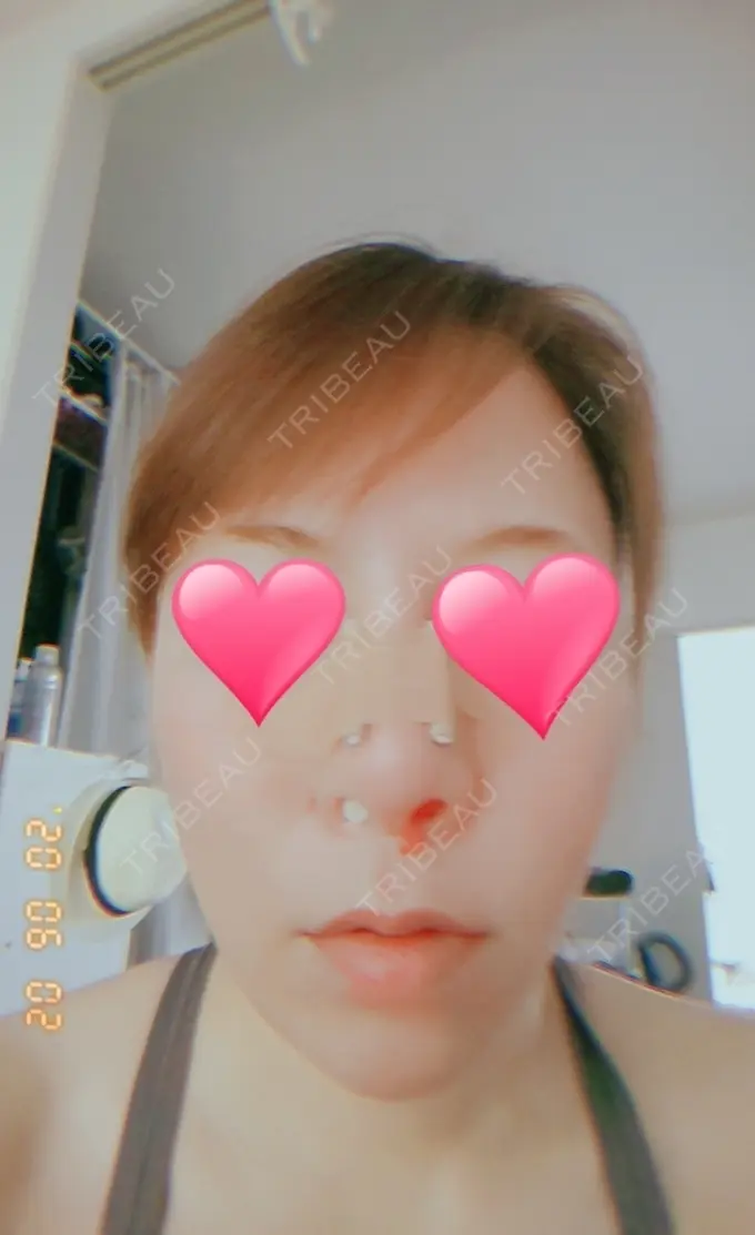 隆鼻術 品川スキンクリニック岡山院 BEFORE メイン用