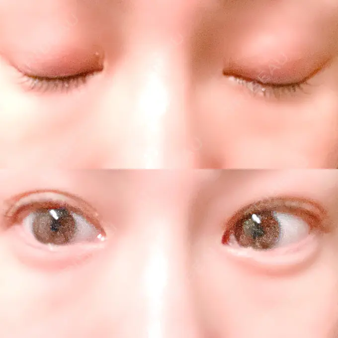 二重埋没 湘南美容クリニック 熊本院 BEFORE メイン用