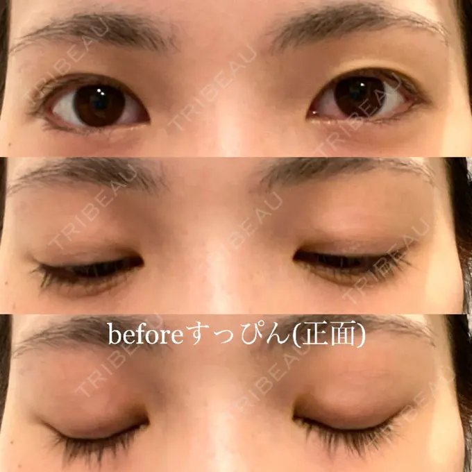 二重切開 有楽町高野美容クリニック BEFORE メイン用