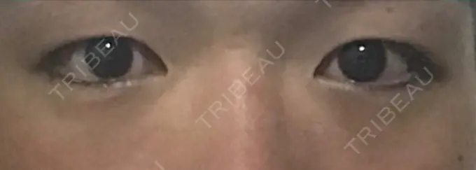 二重埋没 城本クリニック 福岡院 BEFORE メイン用