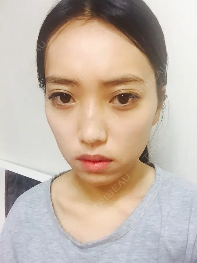 二重埋没 / 隆鼻術 / 鼻尖形成（切開） / 鼻中隔延長（切開） / 骨切り（あご） / 骨削り（エラ） / 骨削り（頬） / 軟骨移植 / ワシ鼻修正・ハンプ切除 DA美容外科 BEFORE メイン用