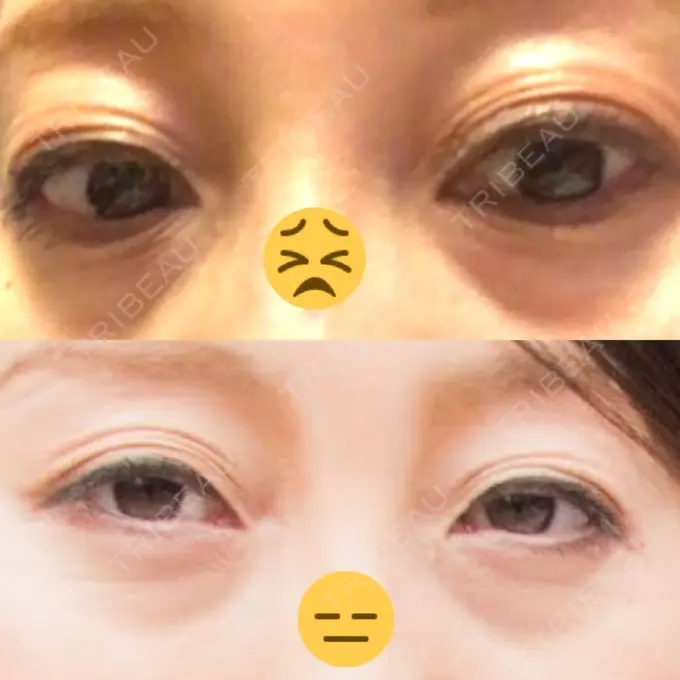 眼瞼下垂（切開） ティーズクリニック BEFORE メイン用