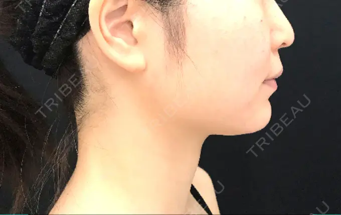 脂肪吸引（顔） / メーラーファット除去 湘南美容クリニック 秋葉原院 BEFORE メイン用