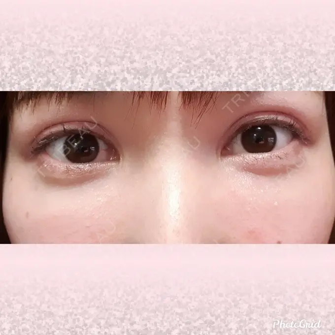 シワ取りボトックス CLASSY 仙台美容外科・美容皮膚科 BEFORE メイン用