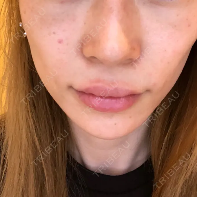 糸リフト / 肌ヒアルロン酸注入（たるみ・シワ改善） / ボトックス（エラ・小顔） 大阪TAクリニック BEFORE メイン用