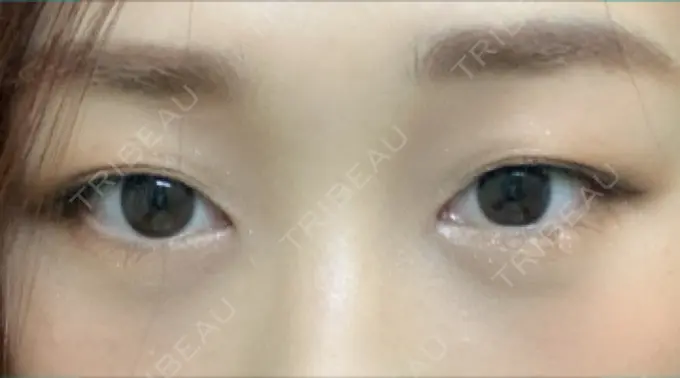 二重埋没 湘南美容クリニック 西宮北口院 BEFORE メイン用