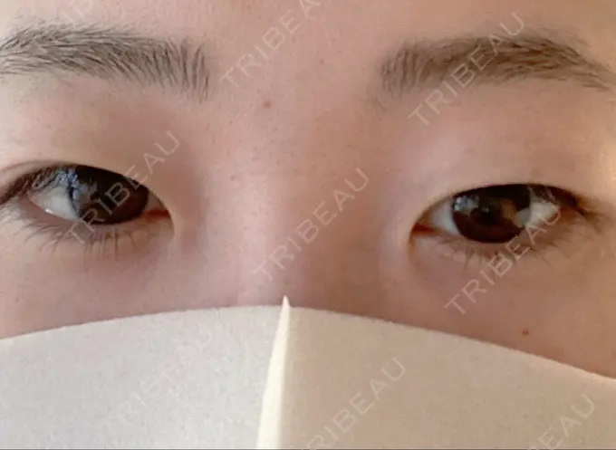 二重埋没 湘南美容クリニック 東京蒲田院 BEFORE メイン用