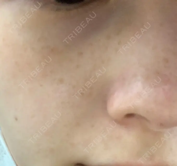 シミ取りレーザー / 美白レーザー よつば会クリニック 森ノ宮院 BEFORE メイン用