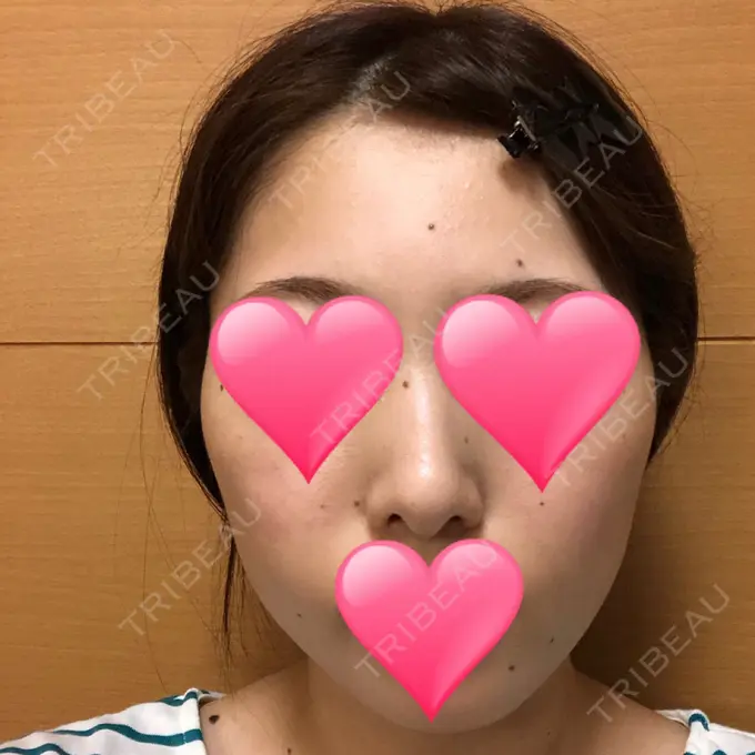 ほくろ・いぼ切除（肌） / バッカルファット除去 / 脂肪吸引（顔） / ヒアルロン酸注入（あご） エートップ美容整形外科 BEFORE メイン用