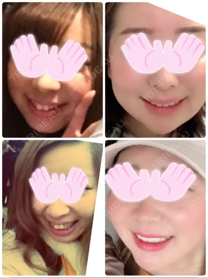 矯正（ワイヤー） 小倉IOI矯正歯科クリニック BEFORE メイン用