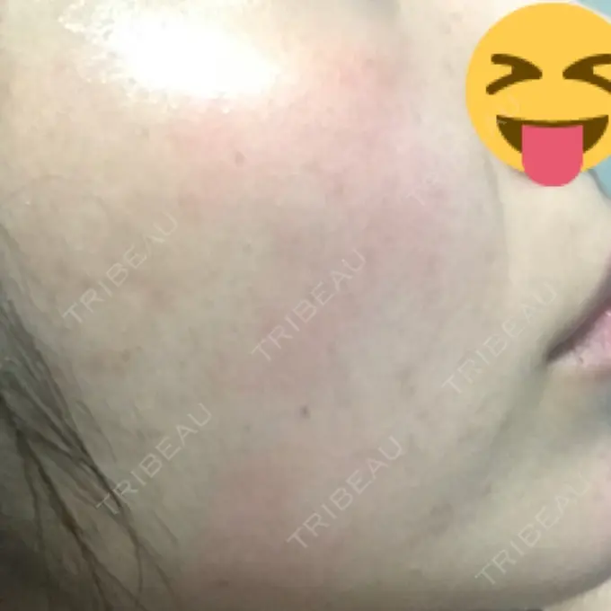 ほくろ・いぼ切除（肌） / ほくろ・いぼ除去レーザー（肌） / 美白レーザー / YAGレーザー REYOUNGクリニック BEFORE メイン用