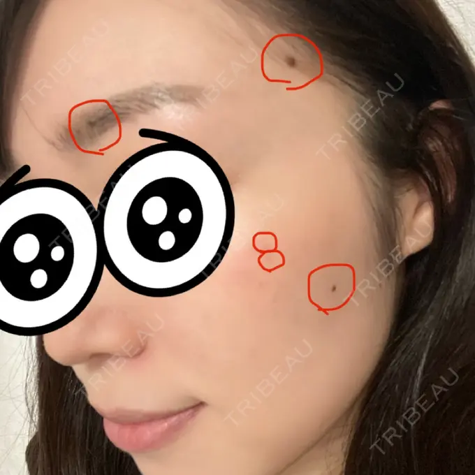 ほくろ・いぼ切除（肌） 医療法人美彩会 グランクリニック BEFORE メイン用