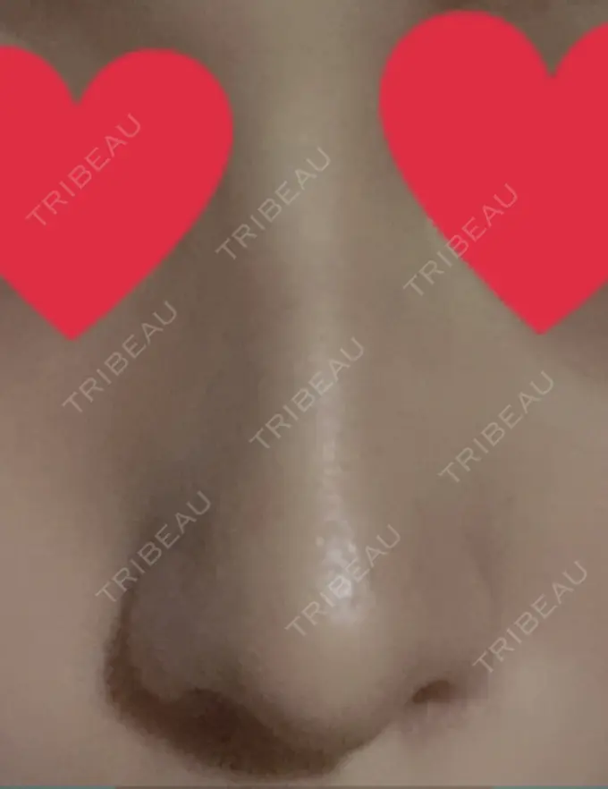 軟骨移植 / 骨切幅寄せ / ワシ鼻修正・ハンプ切除 / 鼻孔縁下降 加美（GAMI）整形外科 BEFORE メイン用