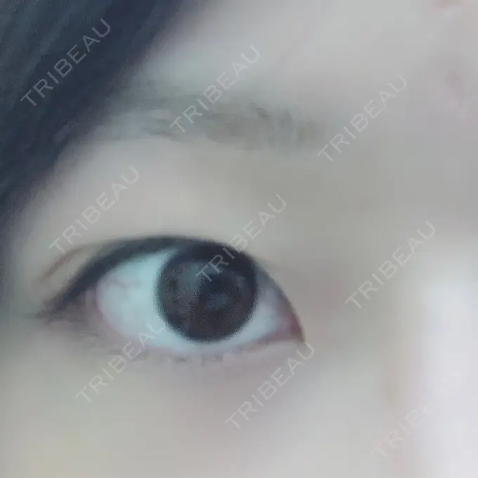 二重埋没 湘南美容クリニック 福島院 BEFORE メイン用