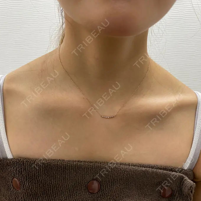 ボトックス（肩） TCB東京中央美容外科 中野院 BEFORE メイン用